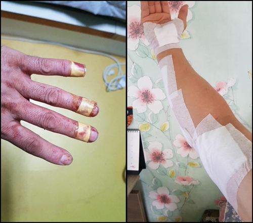 구조 과정에서 다친 손과 팔
