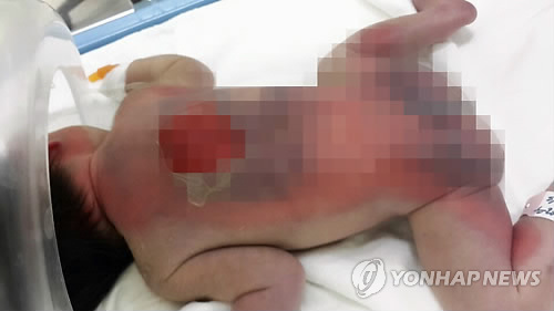 병원 인큐베이터에서 중화상 입은 신생아