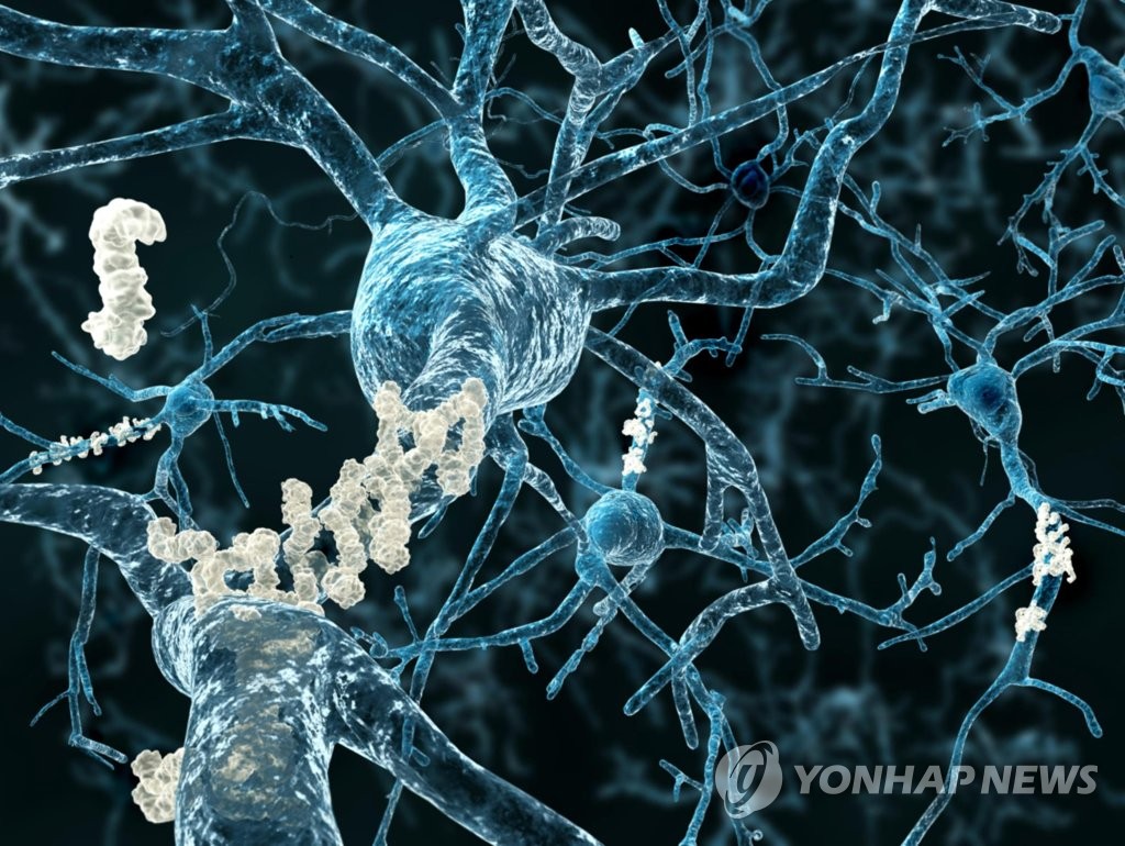 베타아밀로이드 플라크가 형성된 알츠하이머 환자 뇌 신경 